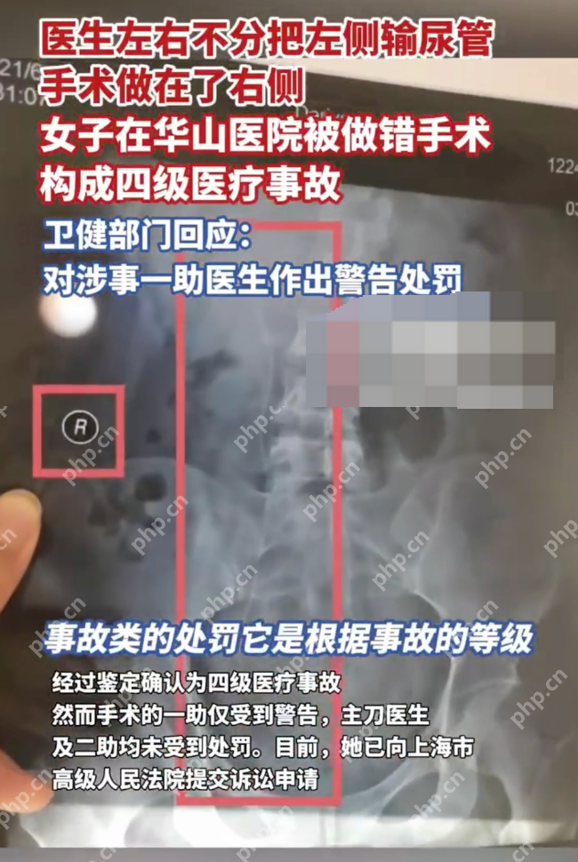 华山医院将左输尿管手术做成右侧是怎么回事?详情介绍 - 创想鸟