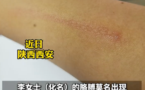 女子误认拉链划伤元凶竟是隐翅虫：伤害力堪比硫酸