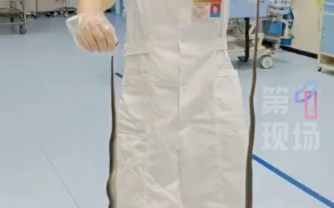 广东老人网鱼网到两条眼镜蛇被咬伤 被咬后手提2条眼镜蛇进急诊