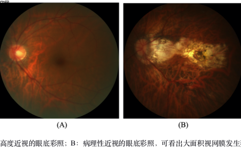 飞桨常规赛：PALM眼底彩照视盘探测与分割 – 8月第2名方案