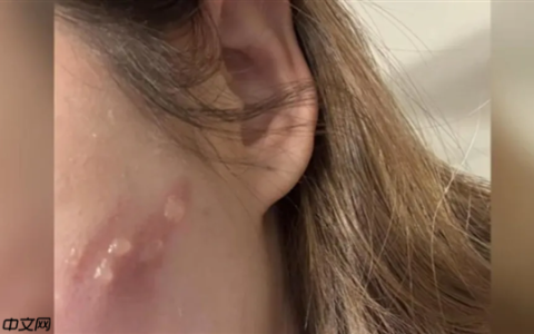 女生玩手机睡着：iPhone贴在脸上直接烫出4颗大水泡！